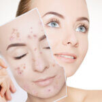 Acne is the most common skin disease in the U.S. that affects all ages & races. Our dermatologist can plan the best acne treatment for you.