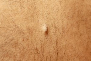 • Epidermoid cysts – These cysts form within hair follicles when the epidermis (outer layer of skin) grows inward toward the follicle rather than being shed away. These cysts are often filled with the skin cells that are unable to be shed.