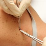 Doctor removing mole from a patient's shoulder.