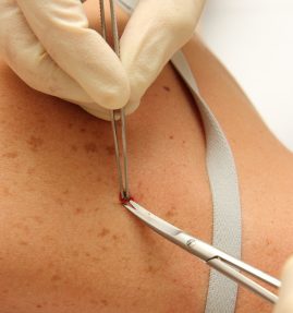 Doctor removing mole from a patient's shoulder.