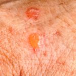 Actinic Keratosis two days after a freezing removal treatment