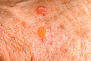 Actinic Keratosis two days after a freezing removal treatment