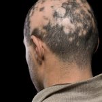 Alopecia areata: View of a man's head with Alopecia Areata