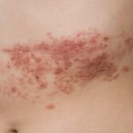 Shingles rash on abdomen.