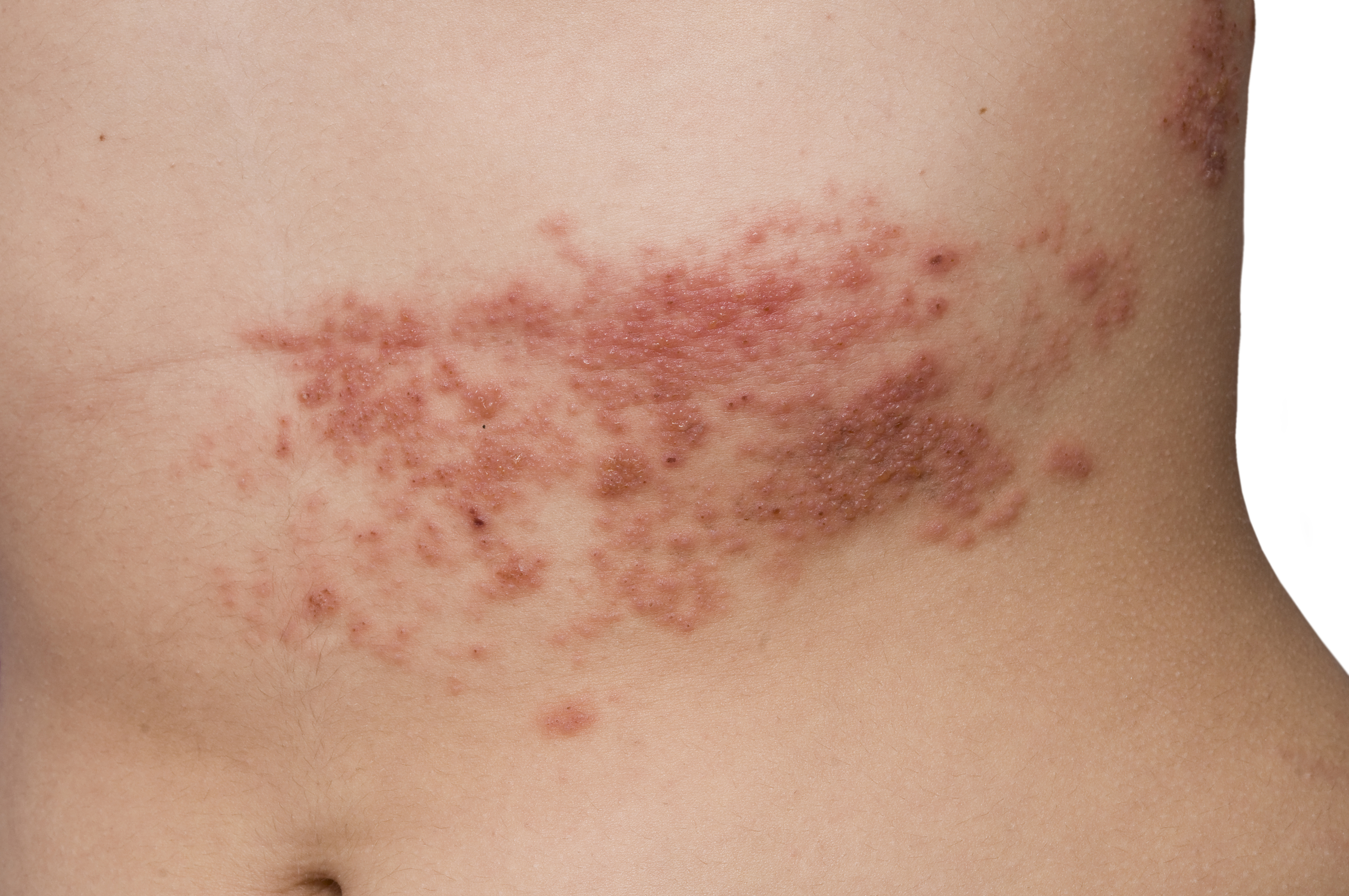 Shingles Rash Shingles Dr Bruce Robinson
