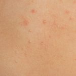 Molluscum Contagiosum