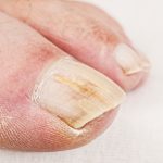 Close-up of a big toe infected with toenail fungus.