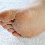 Athletes foot: itchy dry skin affected by athletes foot