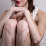 Young woman with vitiligo.