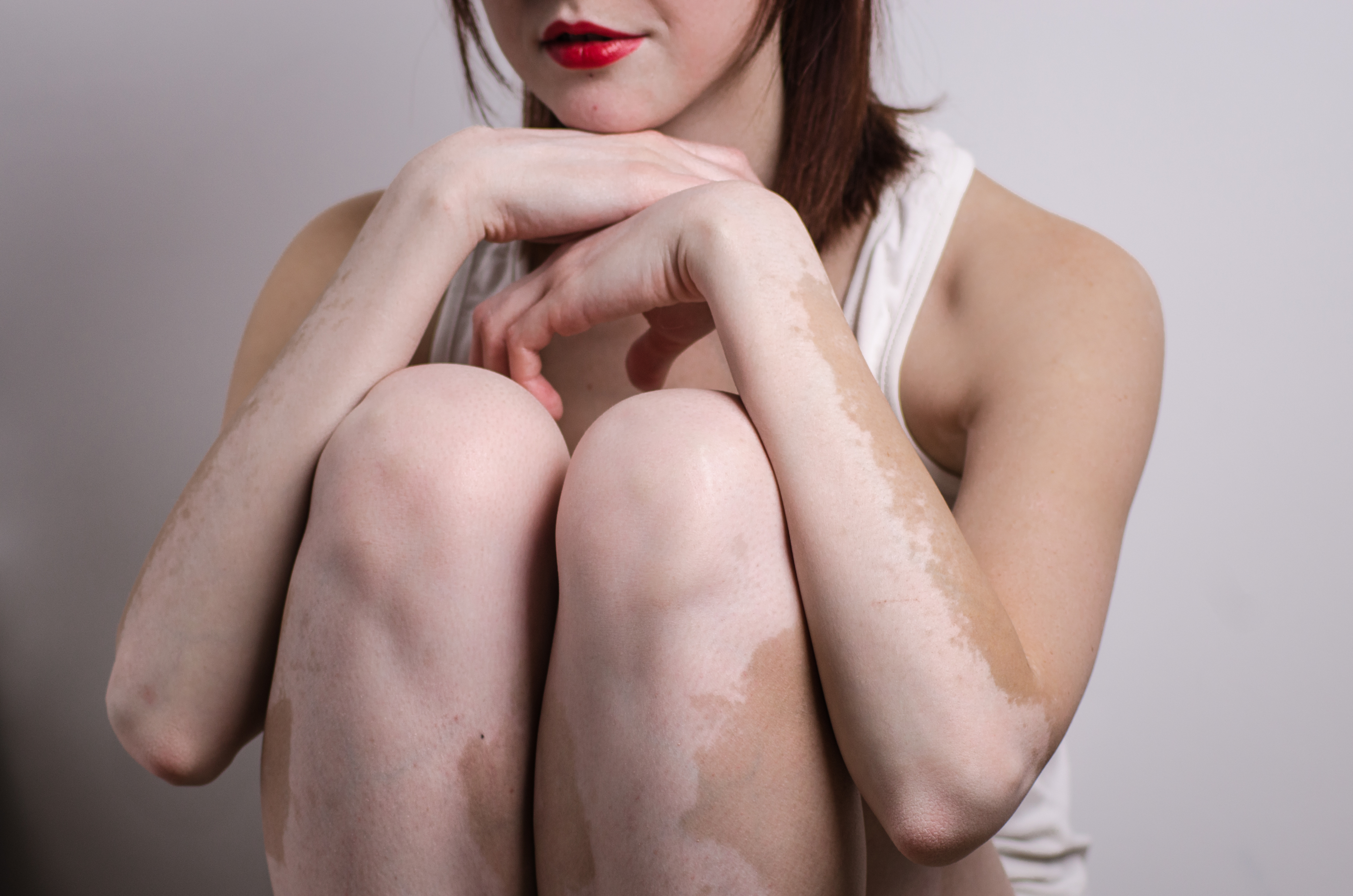 Vitiligo Treatment | U.S. Dermatology Partners