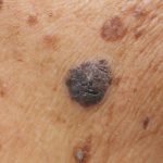 Benign mole on skin