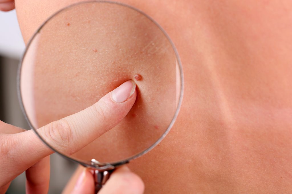 Skin Tag Removal Experts | U.S. Dermatology Partners