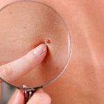 Dermatologist examines a skin tags of patient, close up.