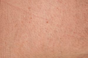 Keratosis pilaris (clogged pores and keratin overproduction) on the skin.