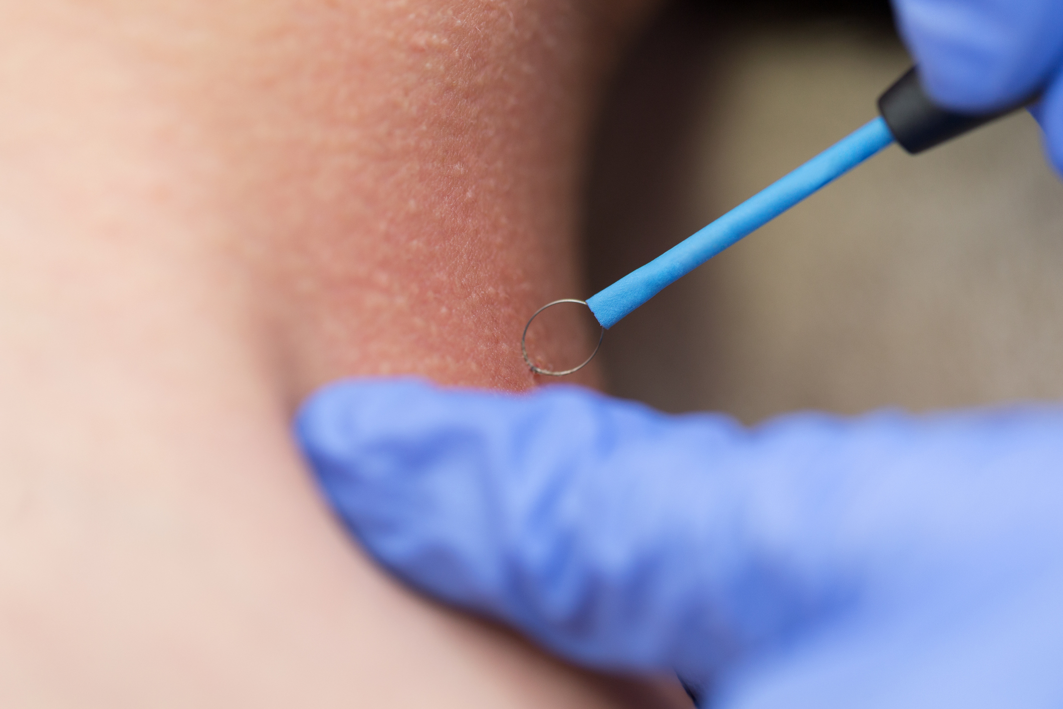 Basal Cell Carcinoma Treatment U.S. Dermatology Partners