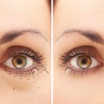 Blepharoplasty procedure before and after
