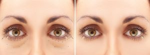 Blepharoplasty procedure before and after