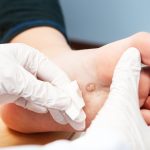 Dermatologist examining a wart on a patient's foot.