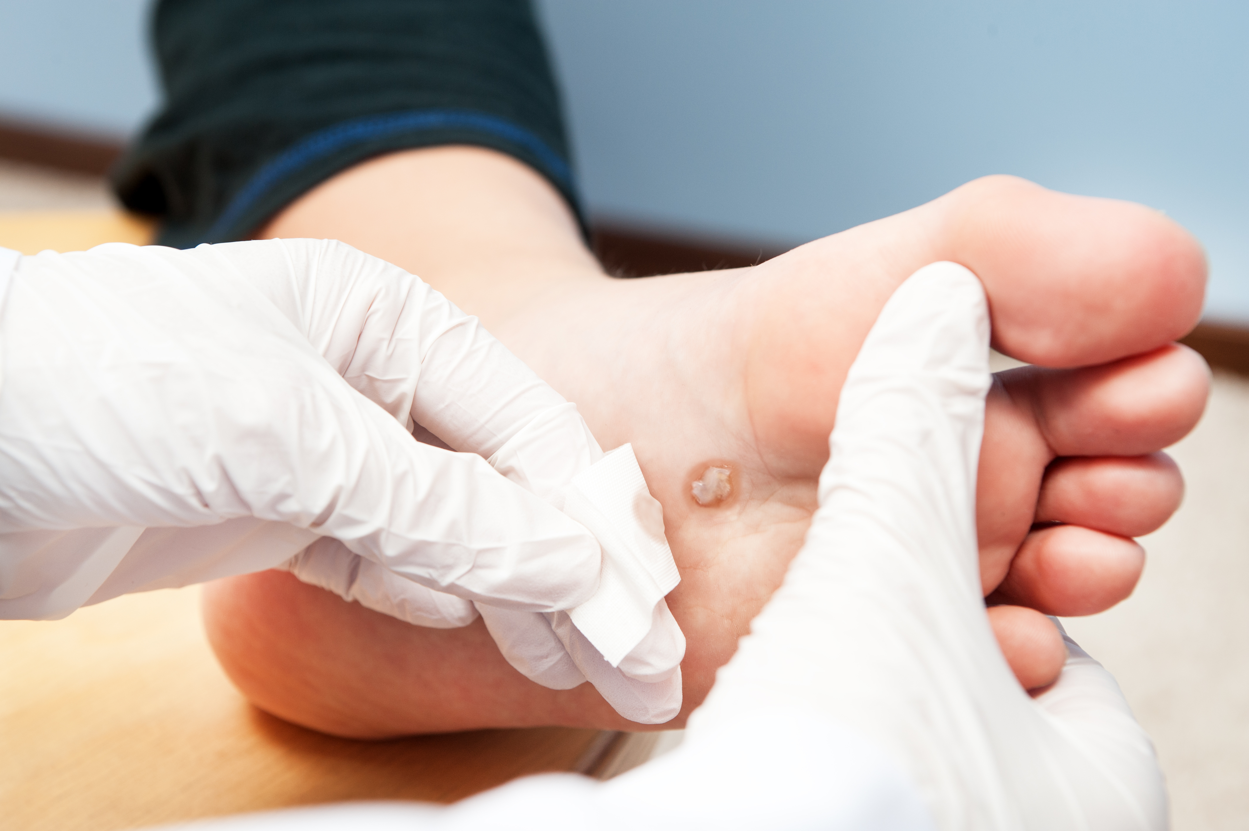 Dermatologist examining a wart on a patient's foot.