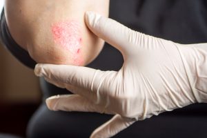 Psoriasis often occurs on the elbows.