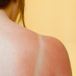 Sun damage occurs over time after repeated or extended exposure to the sun.