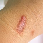 Keloid scars on a patient's wrist.