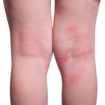 Eczema on a child's legs.