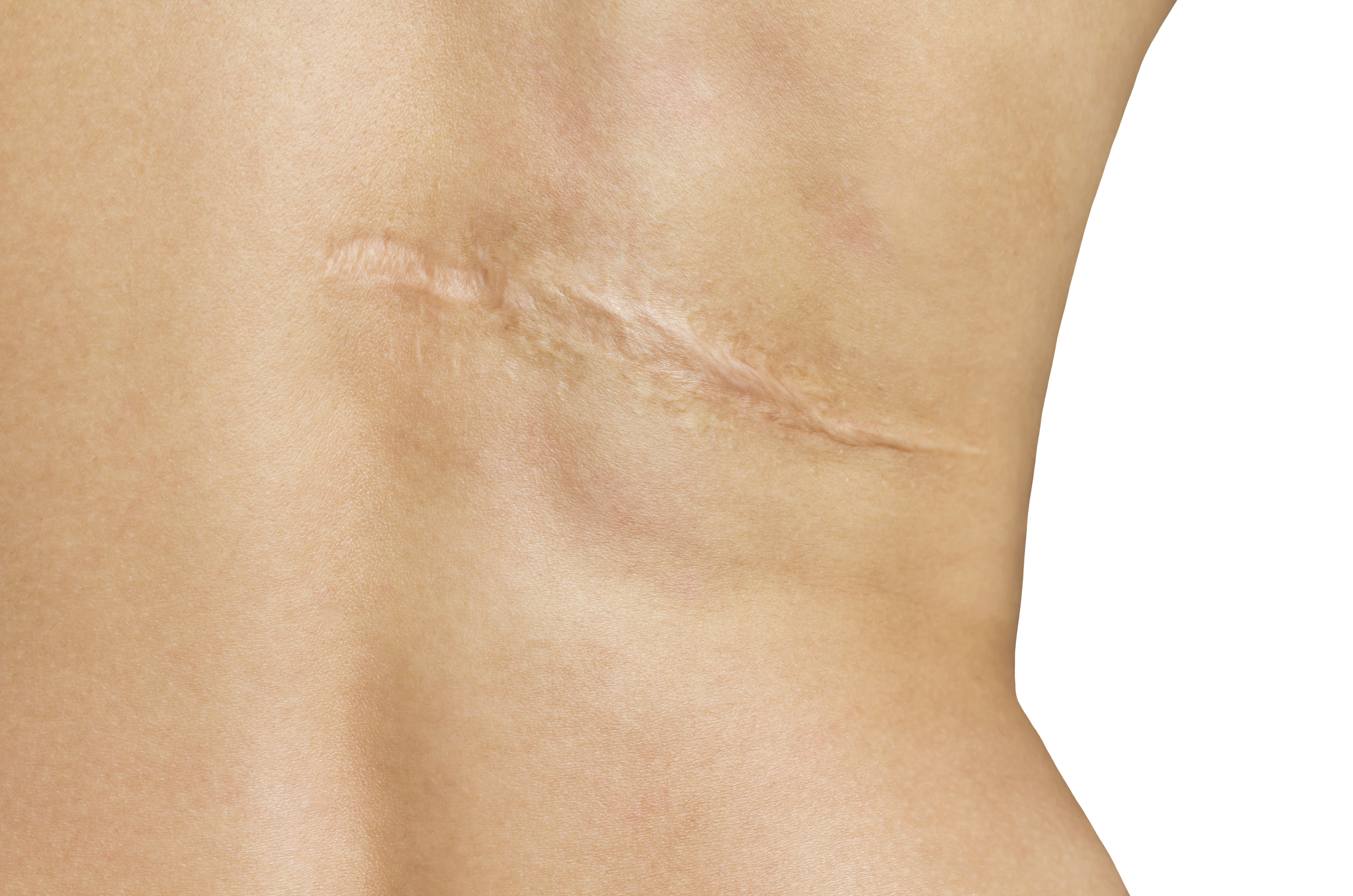 Scar Removal Treatment | U.S. Dermatology Partners