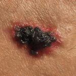 Melanoma skin cancer