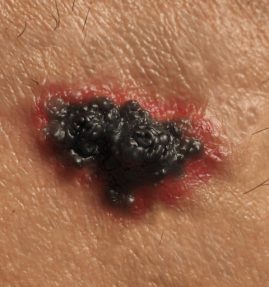 Melanoma skin cancer