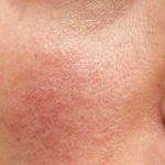 Rosacea Treatmen on facial skin.