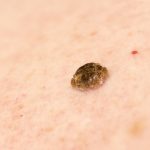 Seborrheic keratosis also known as seborrheic verruca or a senile wart.