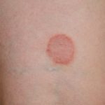 Ringworm on forearm.