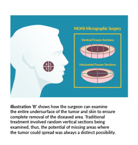 Mohs Surgery diagram