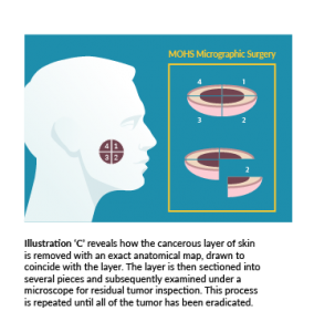 Mohs Surgery diagram