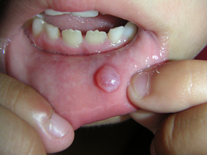 Mucous cysts – These cysts form around the mouth. Typically, mucous cysts develop when the salivary glands are damaged or clogged due to biting the cheek or lip, receiving a piercing, being injured in a sports accident, practicing ineffective oral hygiene, or any other situation where the salivary gland may be damaged.