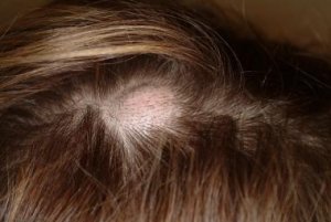 Pilar cyst – A form of cyst that develops within the hair follicle. In many cases, these cysts form on the scalp. Pilar cysts typically fill with keratin, which is what hair and fingernails are made from. 