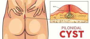 Pilonidal cysts – This type of cyst typically forms in the upper cleft of the buttocks. They are most common in men, and they often form when hairs become ingrown. Without proper treatment and medical attention, these cysts are prone to infection and may increase your risk for developing squamous cell carcinoma, a type of skin cancer.