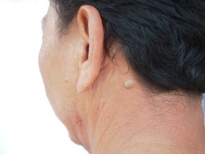 • Sebaceous cysts – These cysts form within the glands that are responsible for producing the skin’s sebum (oil). When the sebum-producing sebaceous glands are damaged or blocked, a cyst can form. This type of cyst is usually filled with oil.