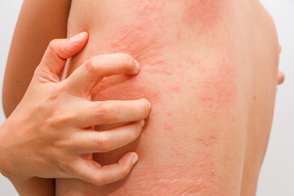 Skin Conditions That Mimic Chronic Hives