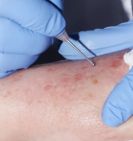 A dermatologist in blue gloves performing a skin procedure on a patient's arm with a specialized tool.