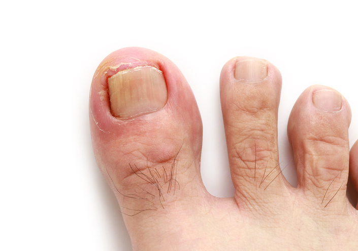 1. Fungal Nail Infection - wide 5