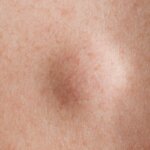 A lipoma is a common, non-cancerous, soft tissue growth just below the skin made up of fat cells. Learn more about lipomas here.