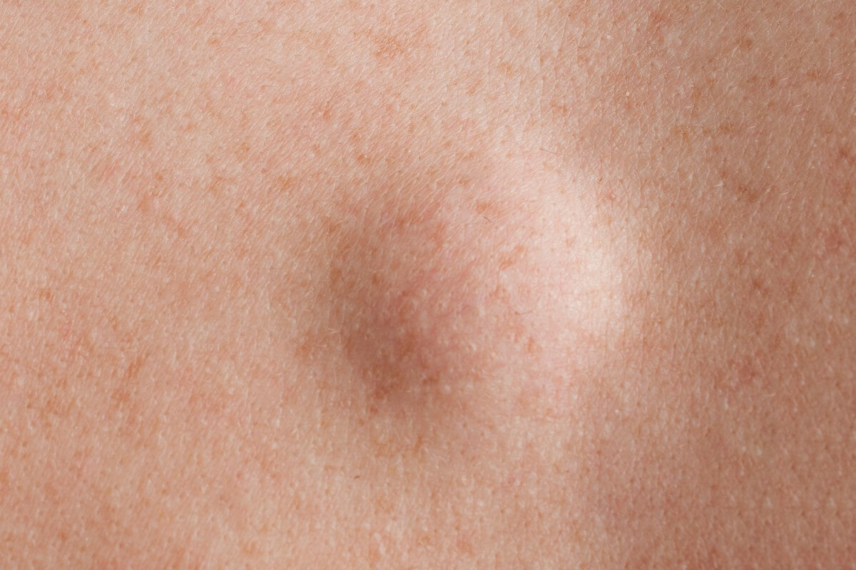 A lipoma is a common, non-cancerous, soft tissue growth just below the skin made up of fat cells. Learn more about lipomas here.