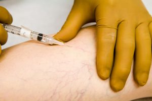 A medical professional in gloves performs a sclerotherapy injection on a patient's leg with side veins.