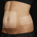 Close-up of a person's abdomen with outlined areas indicating a cosmetic or medical treatment.