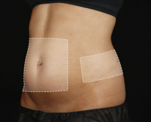 Close-up of a person's abdomen with outlined areas indicating a cosmetic or medical treatment.