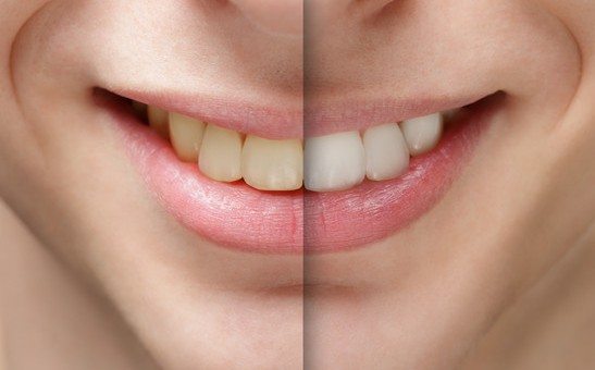 Before and after Teeth Whitening