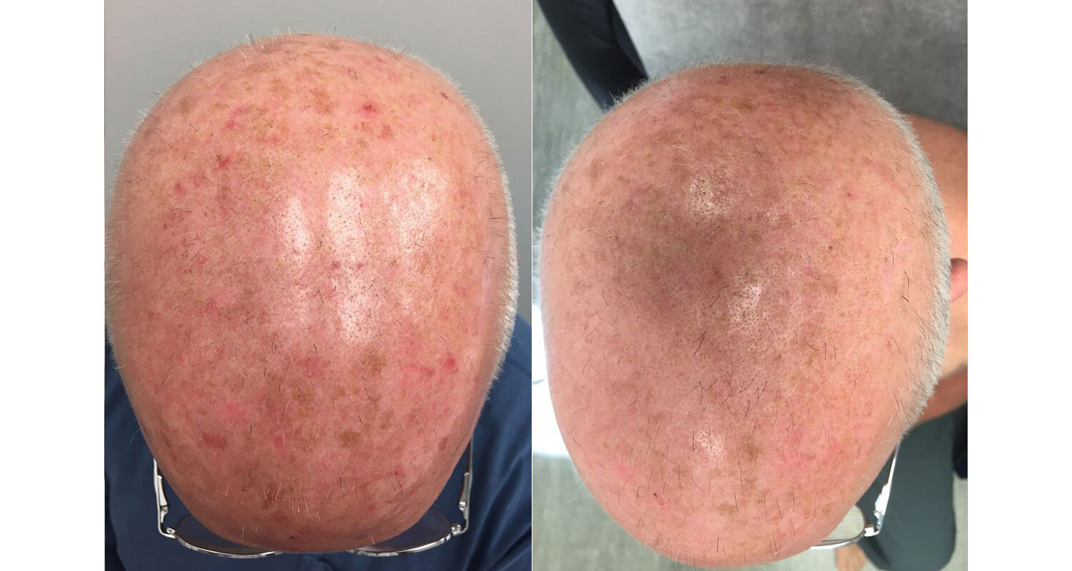 Before After DermAssociates Rockville U S Dermatology Partners Before After DermAssociates Rockville U S Dermatology Partners