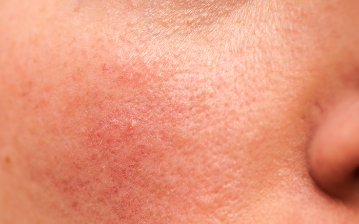 Common Foods That Can Trigger Rosacea Flare Ups common-foods-that-can-trigger-rosacea-flare-ups